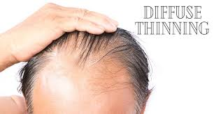 Some men experience what's called diffuse thinning — a type of hair loss that either affects the entire scalp or specific areas like the. Here We Reveal The Startling Fact About Diffuse Thinning