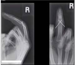 Image result for Lateral PIP Dislocation
