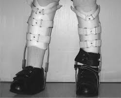 Designed to support, protect and prevent deformity of the hip joint, this orthosis is used to prevent excessive hip flexion or extension and to limit hip abduction (the legs moving together). Proximally Placed Alignment Control Strap For Ankle Varus Deformity A Case Report Archives Of Physical Medicine And Rehabilitation