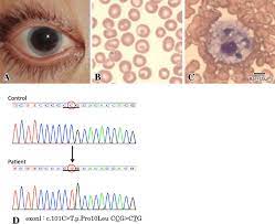 Clinical And Genetic Findings Of Fish Eye Disease A The Patientʼs Download Scientific Diagram