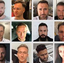 Hallo ihr lieben, hier seht ihr meinen tipp gegen haarausfall, für dicke gesunde haare! Haartransplantation Vorher Nachher Top Ergebnisse Elithair