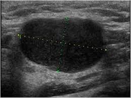 Under the guidance of an ultrasound or ct, the doctor will insert a fine needle to remove a sample of tissue or fluid from the lymph node. Head And Neck 4 4 Lymph Nodes Case 4 4 2 Malignant Lymph Nodes Ultrasound Cases