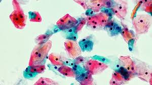 Cervical cancer is a type of cancer that occurs in the cervix, the part of the female reproductive tract that connects the uterus (womb) with the vagina. Cervical Cancer Awareness Month
