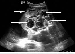 Peritoneal mesothelioma is a rare abdominal disease; Ultrasound Of Abdomen Showing Multiloculated Ascites With Extensive Download Scientific Diagram