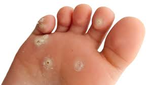 Foot warts are usually on the soles (plantar area) of the feet and are called plantar warts. Warts Johns Hopkins Medicine