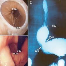 Pdf Open Access Clinical Significance Of Hiatal Hernia