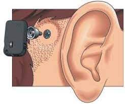 The key to your new sound experience is our unique technology designed to. Local Do Implante Com A Baha Pilar De Ligacao E Implante Osteointegrado Download Scientific Diagram