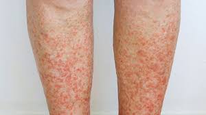 Image result for allergy rash on the legs