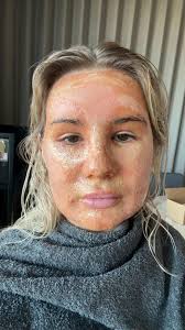 Swelling After Co2 Laser