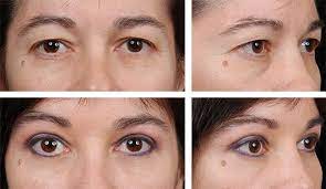 More images for how to remove extra skin on eyelid » Eyelid Surgery And Browlift David Hidalgo Md Facs