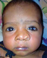 A nostril (or naris /ˈnɛərɪs/, plural nares /ˈnɛəriːz/) is one of the two channels of the nose, from the point where they bifurcate to the external opening. Fosa Nasal Supernumeraria Reporte De Un Caso Y Revision
