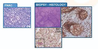 Symptoms include enlarged lymph nodes, fever, night sweats. Non Hodgkin Lymphoma Parkway Cancer Centre Indonesia