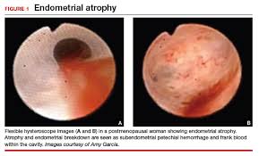 Some are more common as the cancer becomes advanced (grows and spreads). Office Hysteroscopic Evaluation Of Postmenopausal Bleeding Mdedge Obgyn