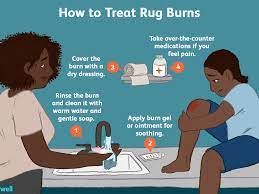 Rug Burns: Symptoms, Severity, Treatment