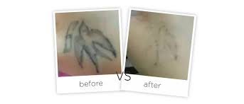 Combine 1 tablespoon of aloe vera gel, 2 capsules of vitamin e, and 1 tablespoon of the gel created by paederia tomentosa leaves. At Home Picosecond Laser Tattoo Removal Equipment Adss Laser