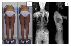 Image result for Functional Leg Length Discrepancy