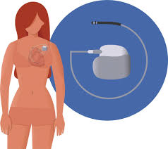 Image result for Internal Cardiac Defibrillator