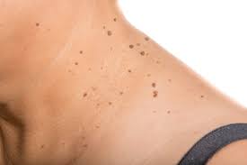 Como Quitar Verrugas En El Cuello Trucos Y Consejos Para Conseguirlo
