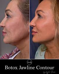 A sharper, more defined jawline—without surgery. 💉✨ Botox isn't just for  smoothing lines… it can also contour the jawline for a slimmer, lifted  look. Treatment by Kylie Stark at Beauty at the