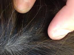 Image result for lice vs dandruff