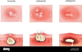 Image result for phlegmon on face)