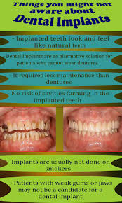 Curious To Learn More About Dental Implants Please Click On The Image Dental Implants Implantdentistry Den Dental Implants Dental Dental Implant Procedure