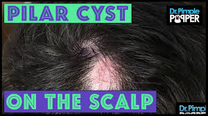 A pilar cyst, also known as trichilemmal cyst, is a small sac that grows mainly on the scalp. Another One Three Pilar Cysts Removed Youtube