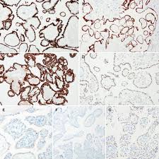 However, fat is the most common tissue invaded by these cells. Clinicopathological Characteristics Of Well Differentiated Papillary Mesothelioma Of The Peritoneum A Single Institutional Experience Of 12 Cases In Vivo