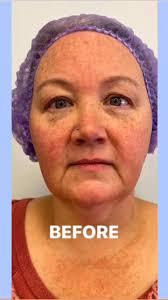 Before and After of Shelby’s Microneedling treatement with the Renewal  Dermal Solution by the FACTORFIVE Skincare !😆 Shelby left with her skin  feeling refreshed, and glowing!✨Message me today to get ...