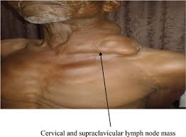 What causes swelling in the lymph glands? Metastatic Cervical And Supraclavicular Lymphadenopathy From Prostate Mimicking Lymphoma A Case Series