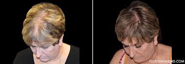 Maybe you would like to learn more about one of these? Stem Cell Hair Restoration Tampa Stem Cell Hair Therapy