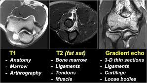 In magnetic resonance imaging (mri) of the elbow, patients are imaged in the supine position or in the prone position with the arm overhead. The Radiology Assistant Mri Examination