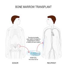 Signs of anemia are tiredness, weakness, and shortness of breath. Bone Marrow Versus Stem Cell Transplant What S The Difference Gift Of Life