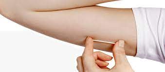 The implant is one of the most effective birth control methods available — it's 99% effective in preventing pregnancy, 1 and it works for up to 3. Birth Control Implant Nurx