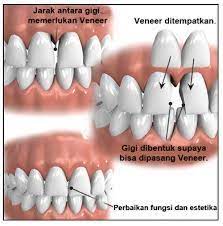 Harga veneer gigi bergantung pada jenis veneer gigi yang anda pilih. Veneer Gigi Macam Prosedur Kelebihan Dan Kekurangannya Dental Id