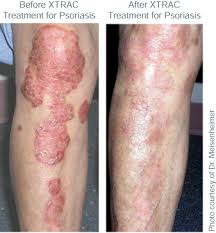 Image result for psoriasis