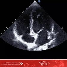 تضخم عضلة القلب heart health celestial bodies cardio