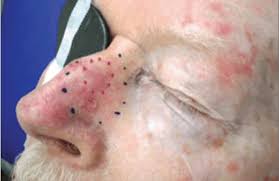 If your doctor tells you that you have adenocarcinoma, it means you have a type of cancer that starts in the glands that line the inside of one of your organs. Squamous Cell Carcinoma Case Study Xstrahl