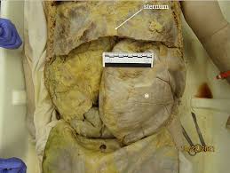 Image result for Megacolon