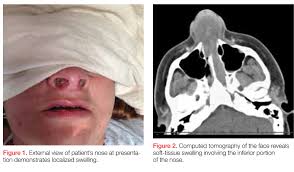 Other signs and symptoms may include fever, headaches, a poor. Case Report Nasal Septal Abscess Clinician Reviews