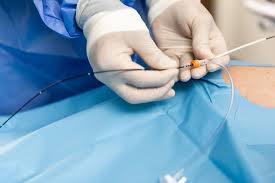 Image result for Radiofrequency Surgery