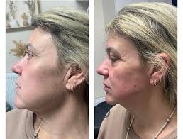 🤩Can we just appreciate these instant results with ENDOLIFT LASER  TREATMENT 🤩 ⭐️ Fat Reduction ⭐️ Skin Tightening ⭐️ Face & Body Contouring  ⭐️ Lasts Up To Five Years ⭐️Continues Working for