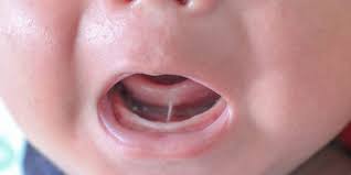 لسان الانسان الزهري by jesika posted on january 15, 2021 و تكون هذه العلامة ظاهرة و يصعب إخفاؤها أيضا و يطلق عليه الناس أن لسان هذا الشخص كلسان الأفعى إذ يتميز هذا النوع من الزوهريين. Ø§Ù„Ù„Ø³Ø§Ù† Ø§Ù„Ù…Ø±Ø¨ÙˆØ· Ø£Ù†ÙˆØ§Ø¹Ù‡ ÙˆØ£Ø³Ø¨Ø§Ø¨Ù‡ ÙˆØ¹Ù„Ø§Ø¬Ù‡