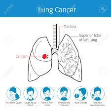 Symptoms of lung cancer can include a persistent cough, shortness of breath, coughing up blood, arm or chest pain, and unexplained weight loss. Illustration Of Human Lungs Outline And Lung Cancer Symptoms Royalty Free Cliparts Vectors And Stock Illustration Image 83248580