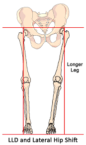 Image result for Functional Leg Length Discrepancy