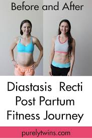 My Diastasis Recti Update Post Partum Belly Post Partum Workout Diastasis Recti Diastasis