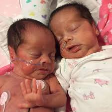 Twins After Tubal Reversal Are Twins Common After Tubal Reversal Tubal Reversal Vasectomy Reversal New Baby Products