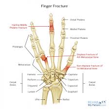 Jan 01, 2017 · 6wks: Finger Fracture Rehab My Patient