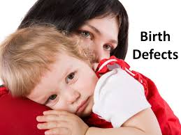Birth Defects.