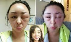 The most common cause of these allergic reactions is. 24 Hair Dye Allergy Ideas Hair Dye Allergy Dyed Hair Hair
